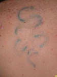 Tattoo Removal - Case #5 After